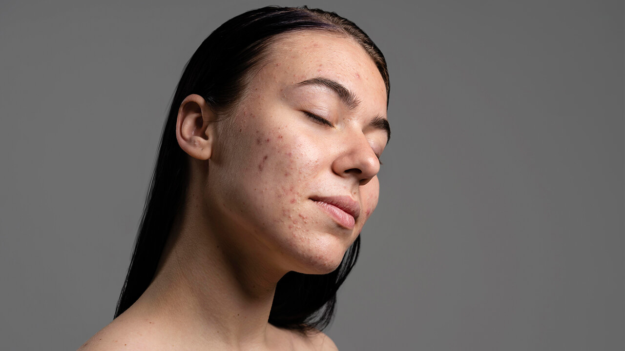 How to Deal with Bad Skin Days