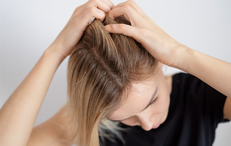 Dandruff Reduction