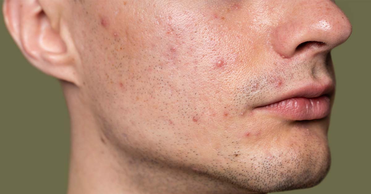 how to remove pigmentation from face permanently