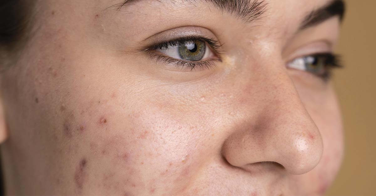 how to remove dark spots on face